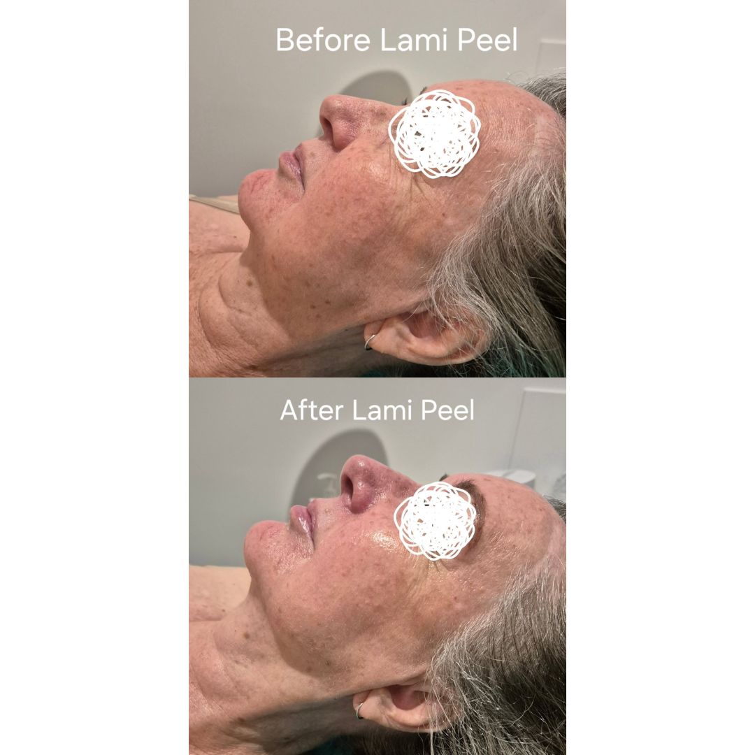 Before and after results after 1 session of the DM Cell Skin Plus Japanese Lamination Peel (LAMI Peel) at Beautiful You By Nadia Bulimba, QLD, revealing refined skin texture, reduced fine lines, lifted appearance, and enhanced skin brightness. @beautifulyoubynadia