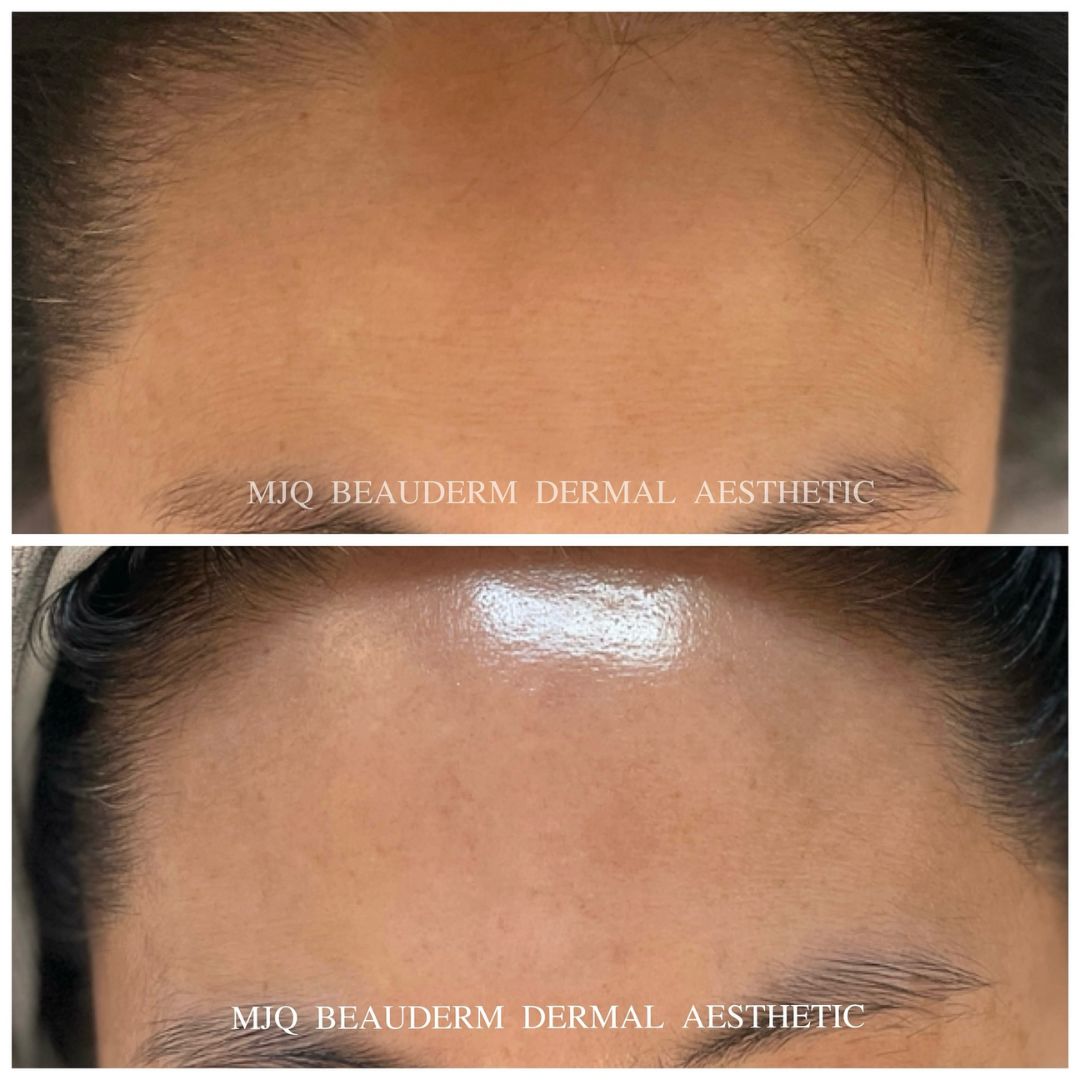 Before and after results of DM Cell Skin Plus Japanese Lamination Peel (LAMI Peel) at MJQ Beauderm Dermal Aesthetic Burnside, VIC, revealing refined skin texture, reduced fine lines, and enhanced skin brightness.