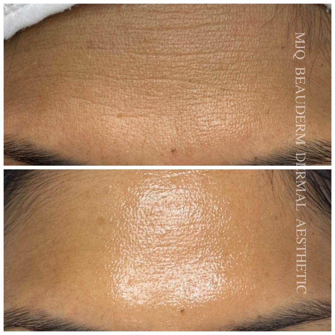 Before and after results of DM Cell Skin Plus Japanese Lamination Peel (LAMI Peel) at MJQ Beauderm Dermal Aesthetic Burnside, VIC, revealing refined skin texture, reduced fine lines, and enhanced skin brightness. @mjqbeaudermdermalaesthetic