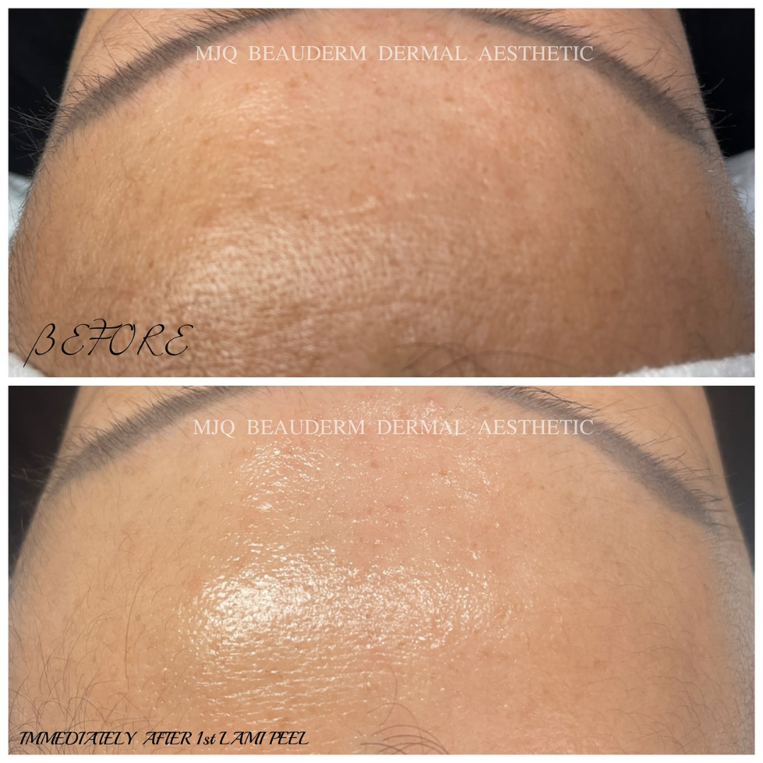 Before and after results of DM Cell Skin Plus Japanese Lamination Peel (LAMI Peel) at MJQ Beauderm Dermal Aesthetic Burnside, VIC, revealing refined skin texture, reduced fine lines, and enhanced skin brightness. @mjqbeaudermdermalaesthetic