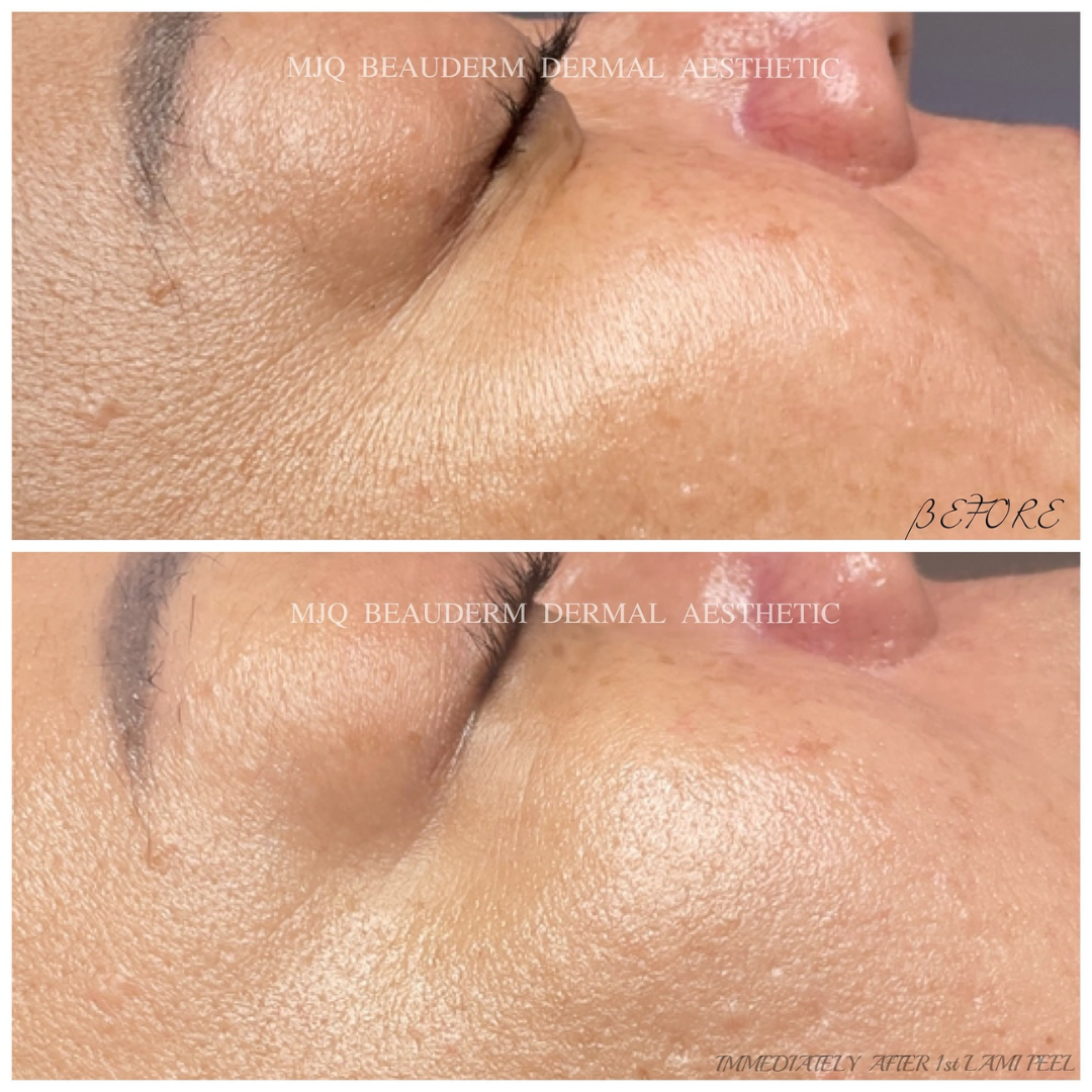 Before and after results of DM Cell Skin Plus Japanese Lamination Peel (LAMI Peel) at MJQ Beauderm Dermal Aesthetic Burnside, VIC, revealing refined skin texture, reduced fine lines, and enhanced skin brightness. @mjqbeaudermdermalaesthetic