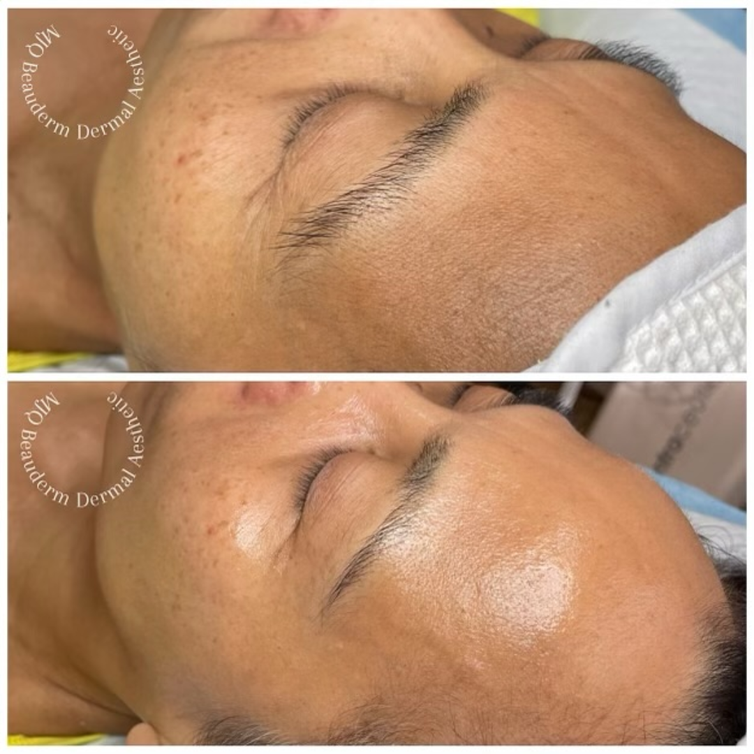 Before and after results of DM Cell Skin Plus Japanese Lamination Peel (LAMI Peel) at MJQ Beauderm Dermal Aesthetic Burnside, VIC, revealing refined skin texture, reduced fine lines, and enhanced skin brightness. @mjqbeaudermdermalaesthetic