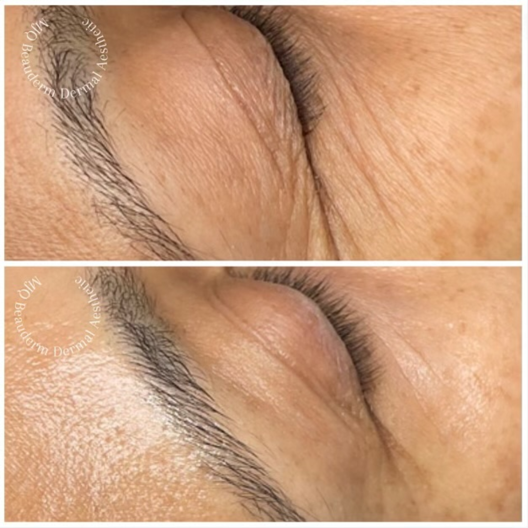 Before and after results of DM Cell Skin Plus Japanese Lamination Peel (LAMI Peel) at MJQ Beauderm Dermal Aesthetic Burnside, VIC, revealing refined skin texture, reduced fine lines, and enhanced skin brightness. @mjqbeaudermdermalaesthetic