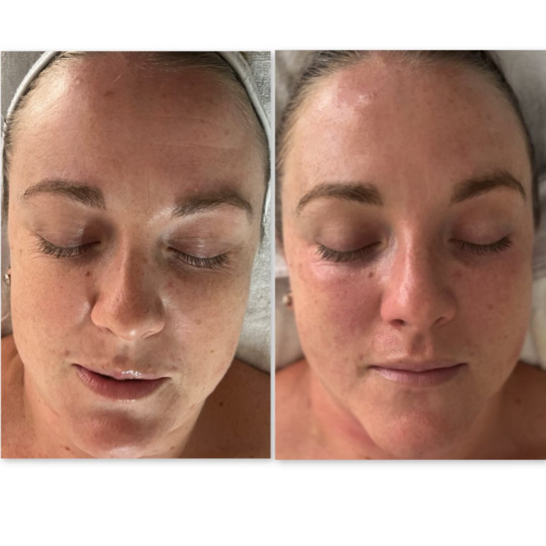 Before and after results of DM Cell Skin Plus Japanese Lamination Peel (LAMI Peel) at Skin By Sculpted Mooloolaba, QLD @skinbysculpted showing improved hydration, reduced fine lines, refined skin texture and even tone.