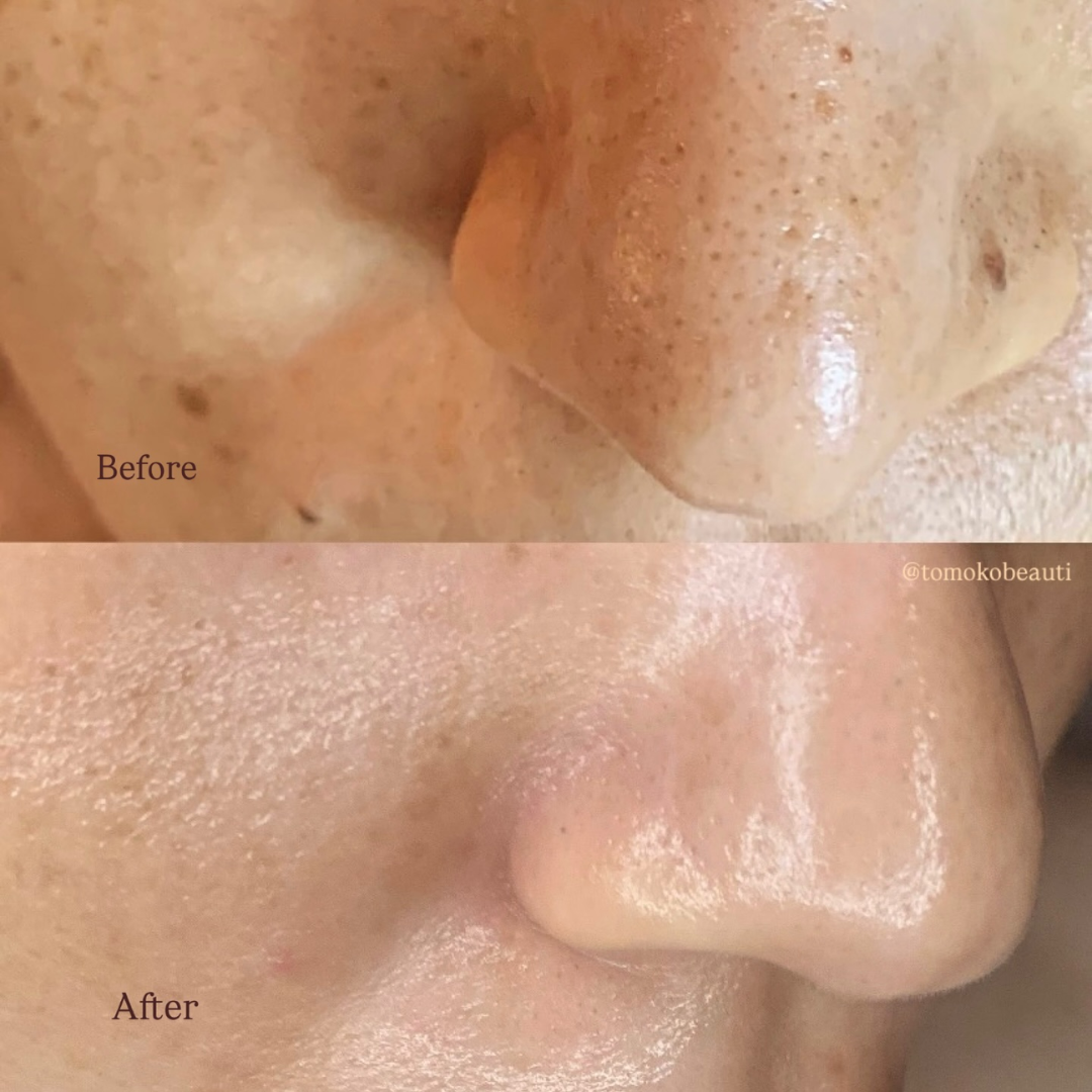 Before and after results of DM Cell Skin Plus Japanese Lamination Peel (LAMI Peel), at Tomoko Beauti, Sydney, Burwood, NSW showing clean, tighter pores, improved hydration, refined skin texture and enhanced skin brightness. @tomokobeauti
