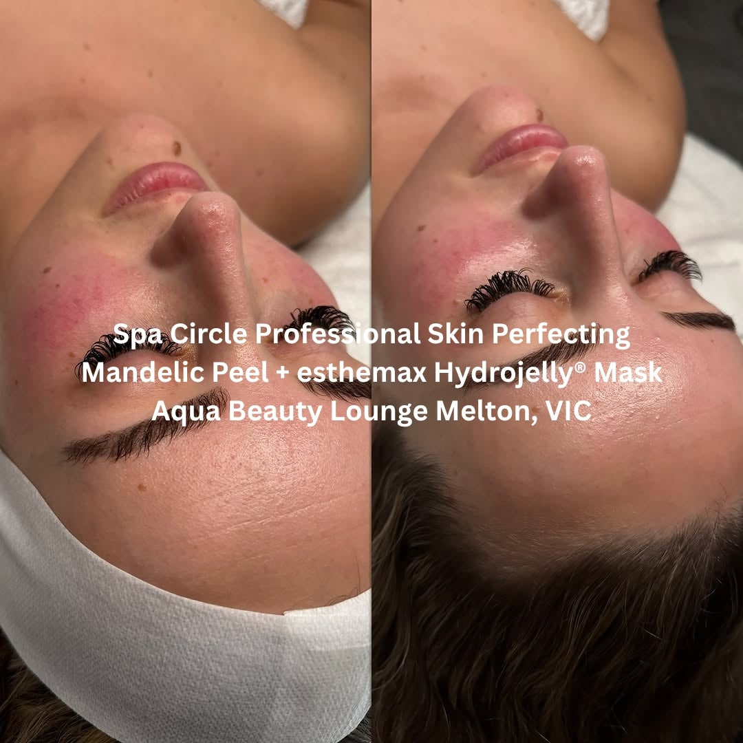 Before and after results after the Spa Circle Professional Mandelic Peel combined with esthemax Hydrojelly® Mask at Aqua Beauty Lounge Melton, VIC, showing calmer, clearer skin with a renewed glow.