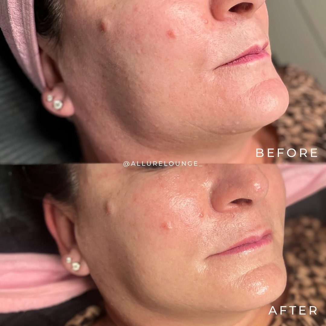 Before and after results of esthemax Argireline Contouring Mask (Lymphatic Mask) at Allure Lounge Ferntree Gully, Melbourne, VIC @allurelounge_ showing hydrated skin with boosted vitality and refined texture.