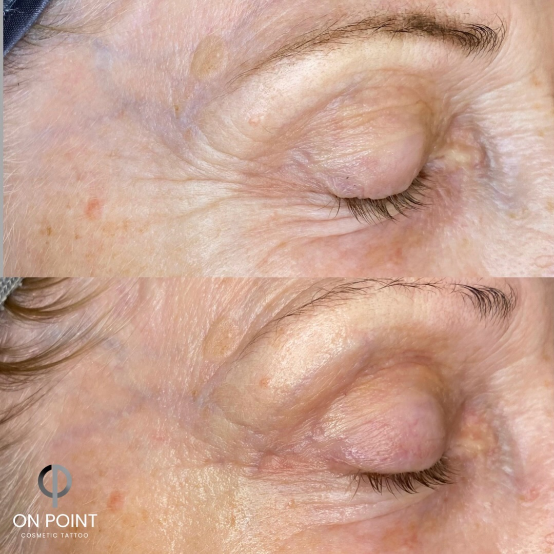Before and after results after the esthemax Argireline Contouring Mask (Lymphatic Mask) at On Point Cosmetic Tattoo Grange, SA @onpointcosmetictattoo.au revealing refined skin texture, reduced fine lines around the eyes, and even tone.