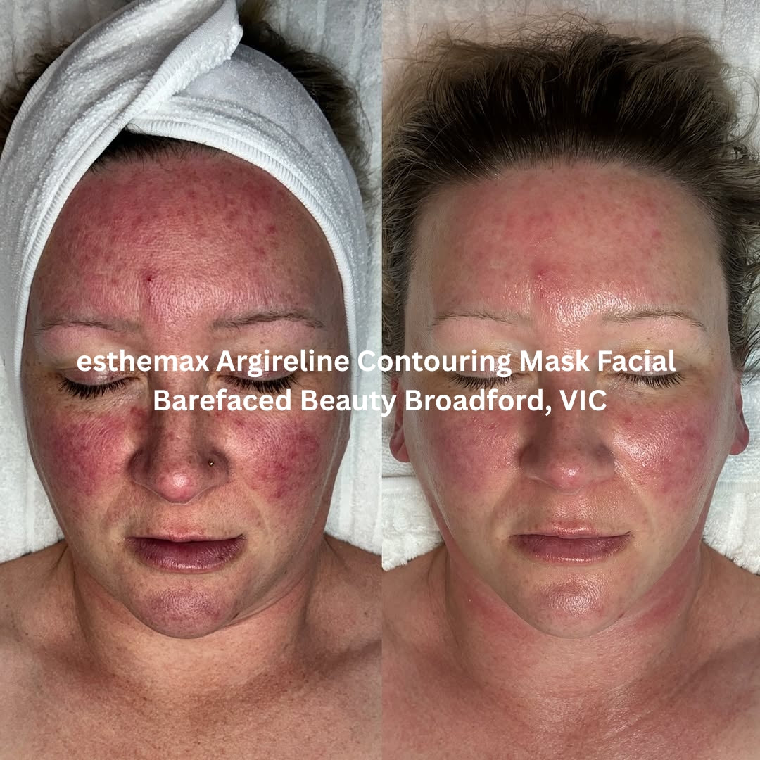 Before and after results after the esthemax Argireline Contouring Mask Facial at Barefaced Beauty Broadford, VIC, showing visibly reduced redness, improved tone, and firmer skin.