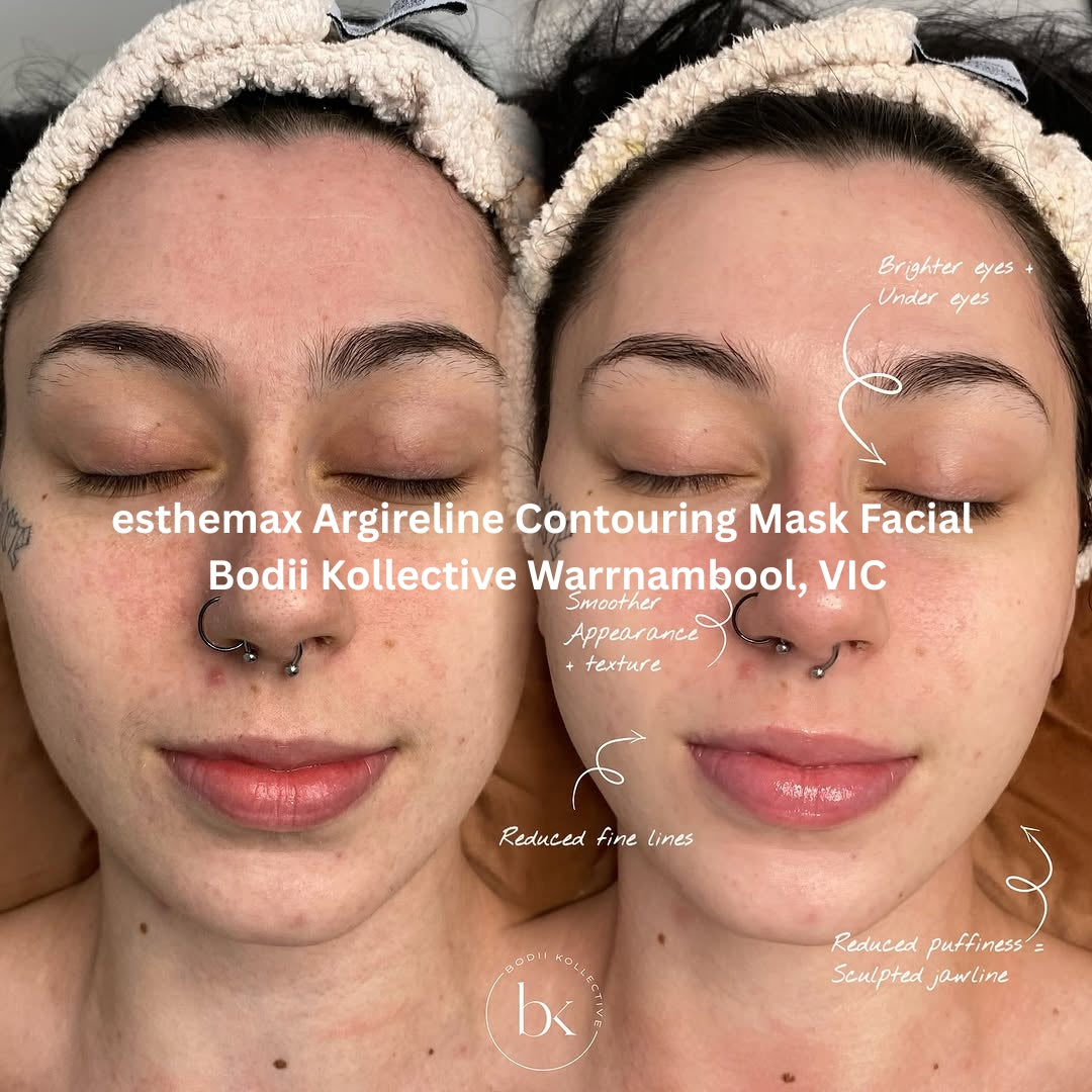 Before and after results after the esthemax Argireline Contouring Mask Facial at Bodii Kollective Warrnambool, VIC, revealing brighter eyes, reduced fine lines, and a smoother, sculpted finish.