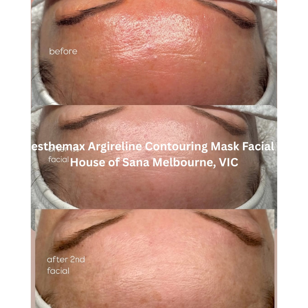 Before and after results after the esthemax Argireline Contouring Mask Facial at House of Sana Melbourne, VIC, showing smoother forehead lines and visibly improved clarity after two sessions.