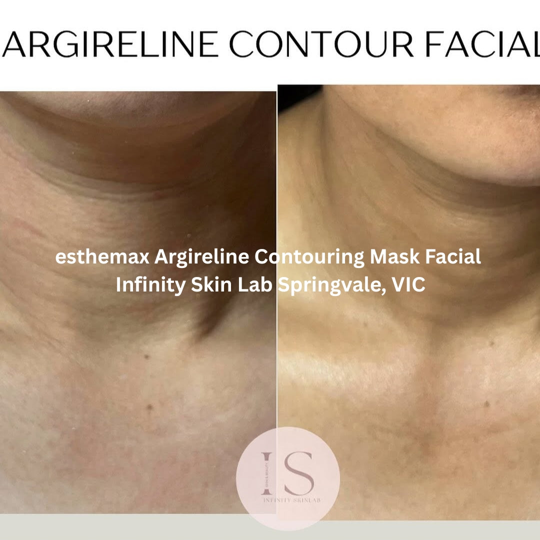Before and after results after the esthemax Argireline Contouring Mask Facial at Infinity Skin Lab Springvale, VIC, showing refined texture, improved firmness, and a more lifted neckline.