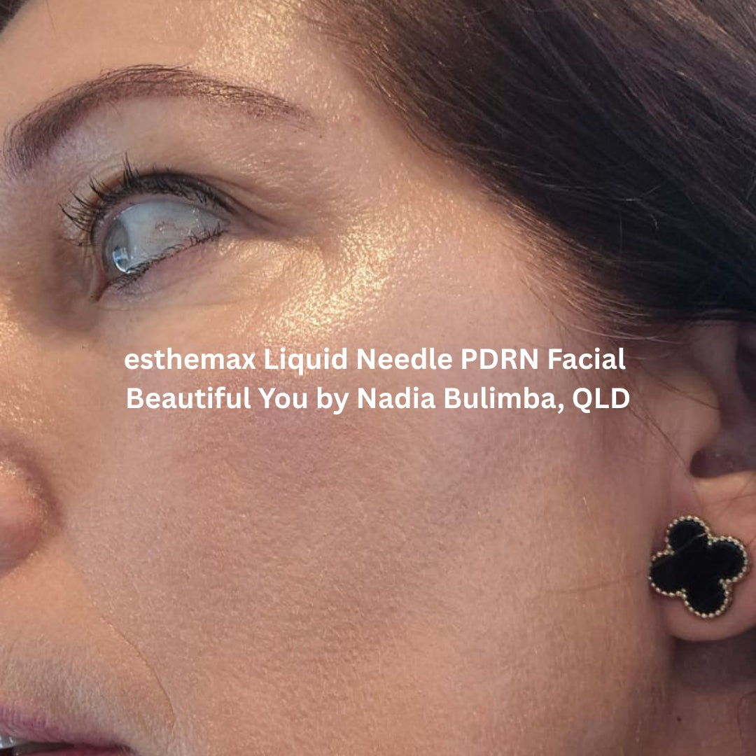 Seven days post-treatment results after the esthemax Liquid Needle PDRN Facial at Beautiful You by Nadia, Bulimba, QLD, showing smoother skin, refined lines, and a radiant, even complexion.