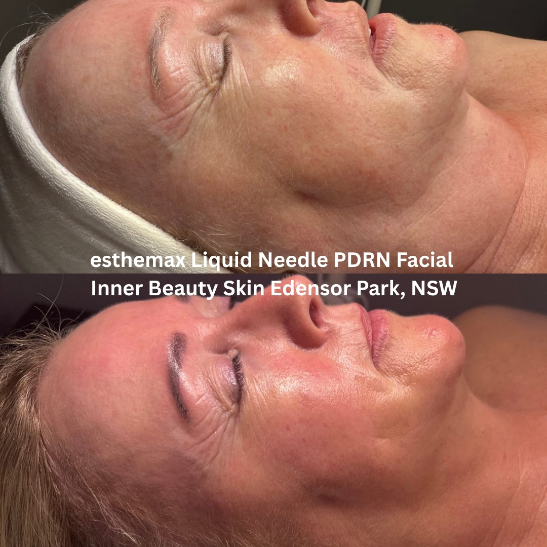 Before and after results after the esthemax Liquid Needle PDRN Facial at Inner Beauty Skin Edensor Park, NSW, showing visibly firmer skin, reduced fine lines, and improved hydration.