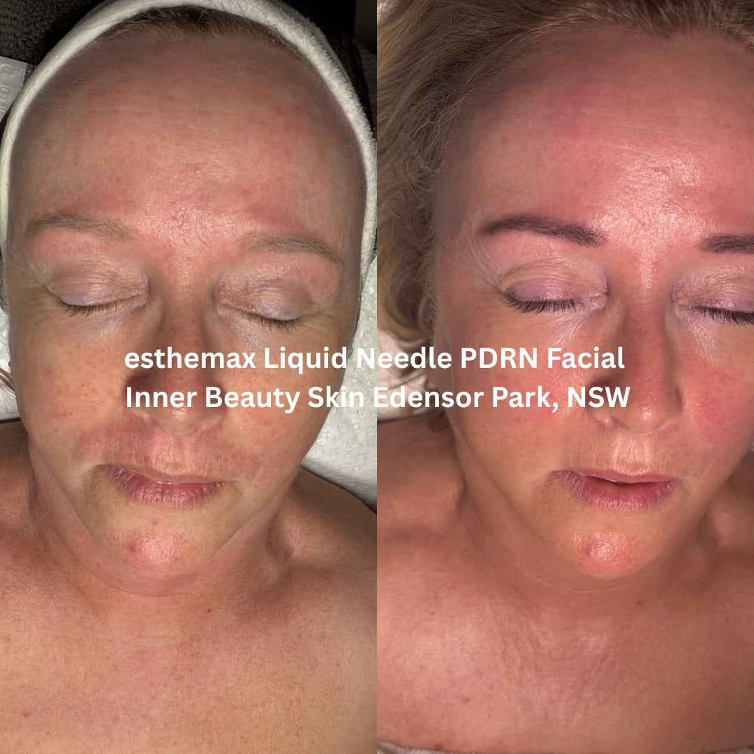 Before and after results after the esthemax Liquid Needle PDRN Facial at Inner Beauty Skin Edensor Park, NSW, revealing brighter, lifted skin with improved elasticity and glow.
