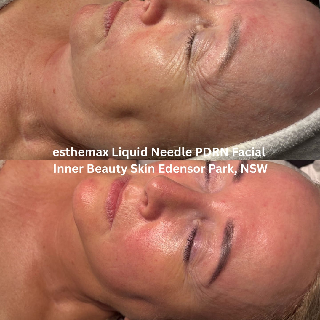 Before and after results after the esthemax Liquid Needle PDRN Facial at Inner Beauty Skin Edensor Park, NSW, revealing brighter, lifted skin with improved elasticity and glow.