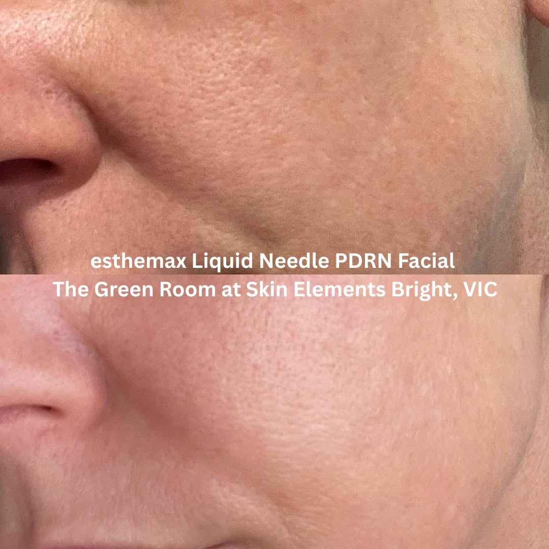 Before and after results after the esthemax Liquid Needle PDRN Facial at The Green Room, Skin Elements Bright, VIC, showing smoother texture, refined pores, and firmer skin.