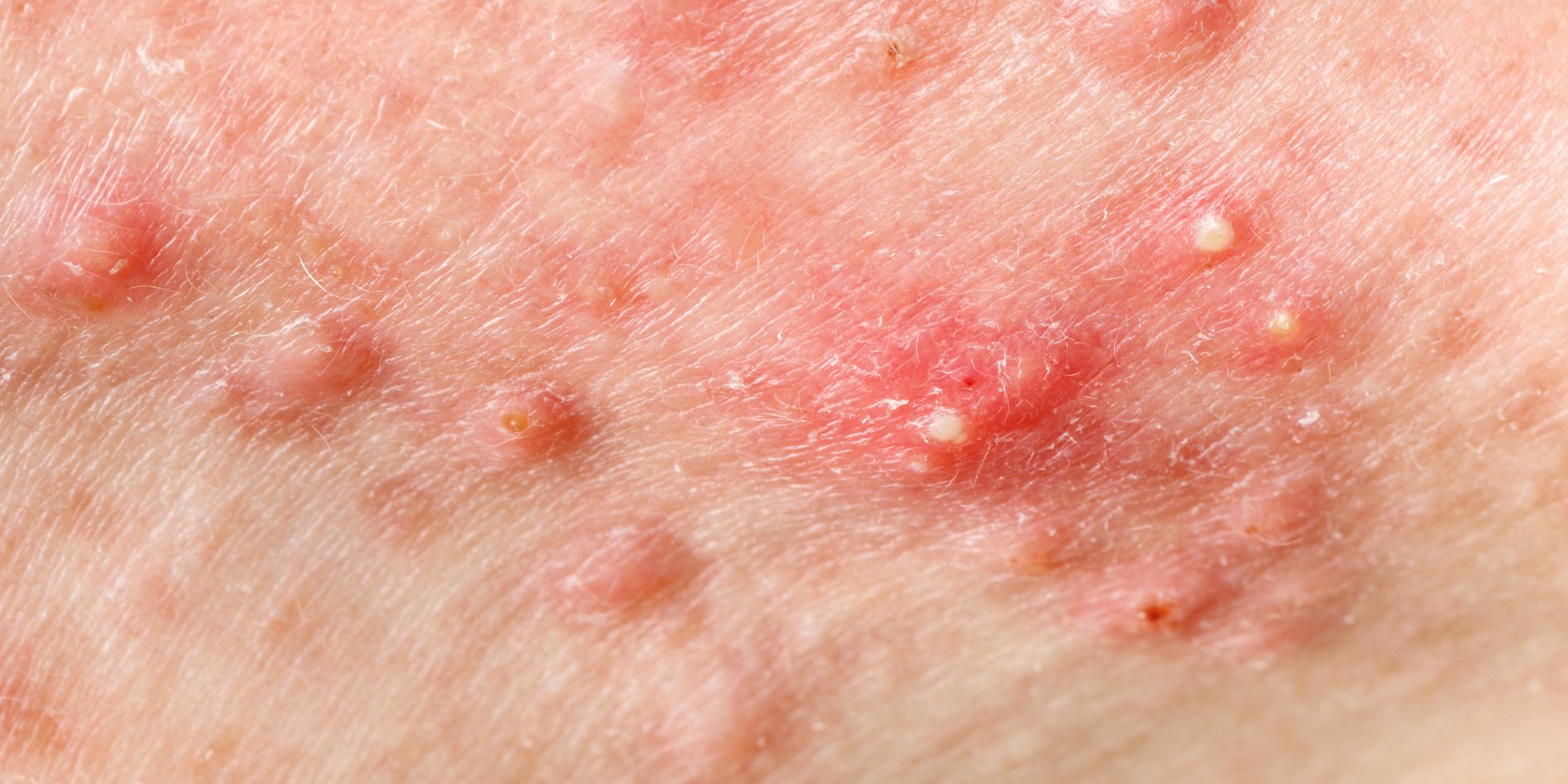 Achieving Clear Skin: How Professional Spa Treatments and Homecare Products Can Help Combat Acne - Esthemax Australia