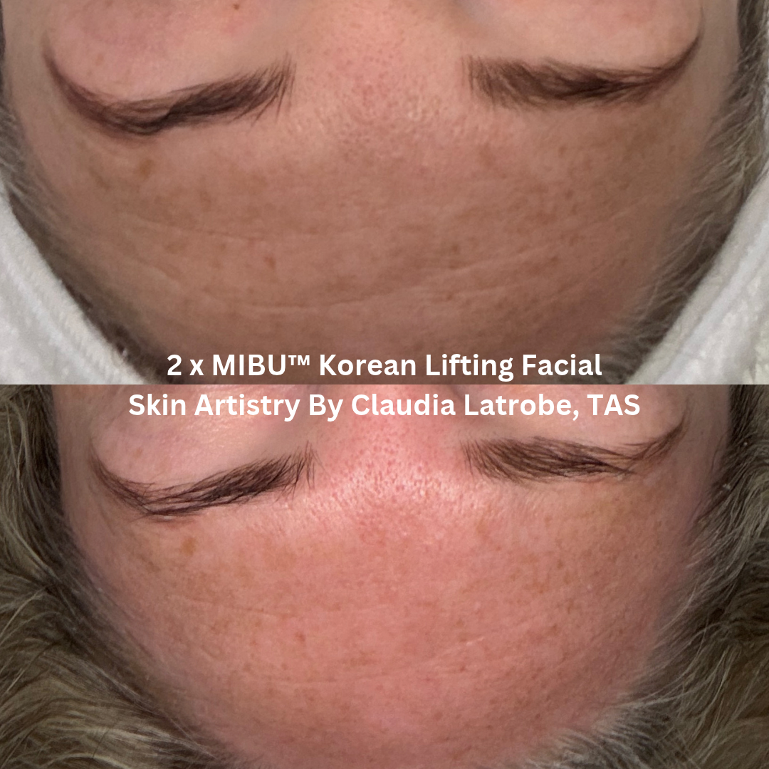 Before and after two MIBU™ Korean Lifting Facial treatments at Skin Artistry By Claudia, Latrobe TAS, showing smoother-looking forehead lines, improved skin texture and a more refreshed appearance.
