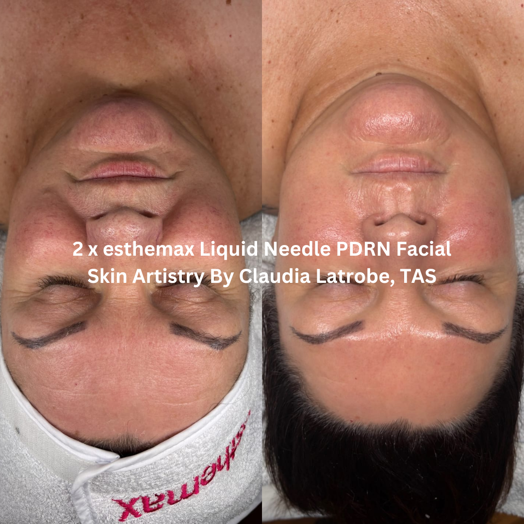 Before and after two esthemax Liquid Needle PDRN Facial treatments at Skin Artistry By Claudia, Latrobe TAS, showing a more luminous, hydrated-looking complexion with smoother skin texture and enhanced radiance.