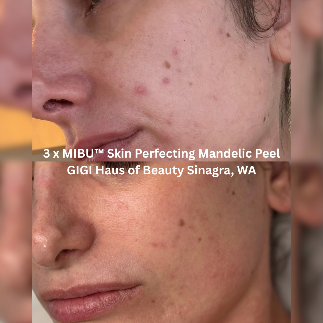 Before and after three MIBU™ Skin Perfecting Mandelic Peel treatments at GIGI Haus of Beauty, Sinagra WA, showing reduced visibility of blemishes, smoother-looking cheek texture and a more even complexion.