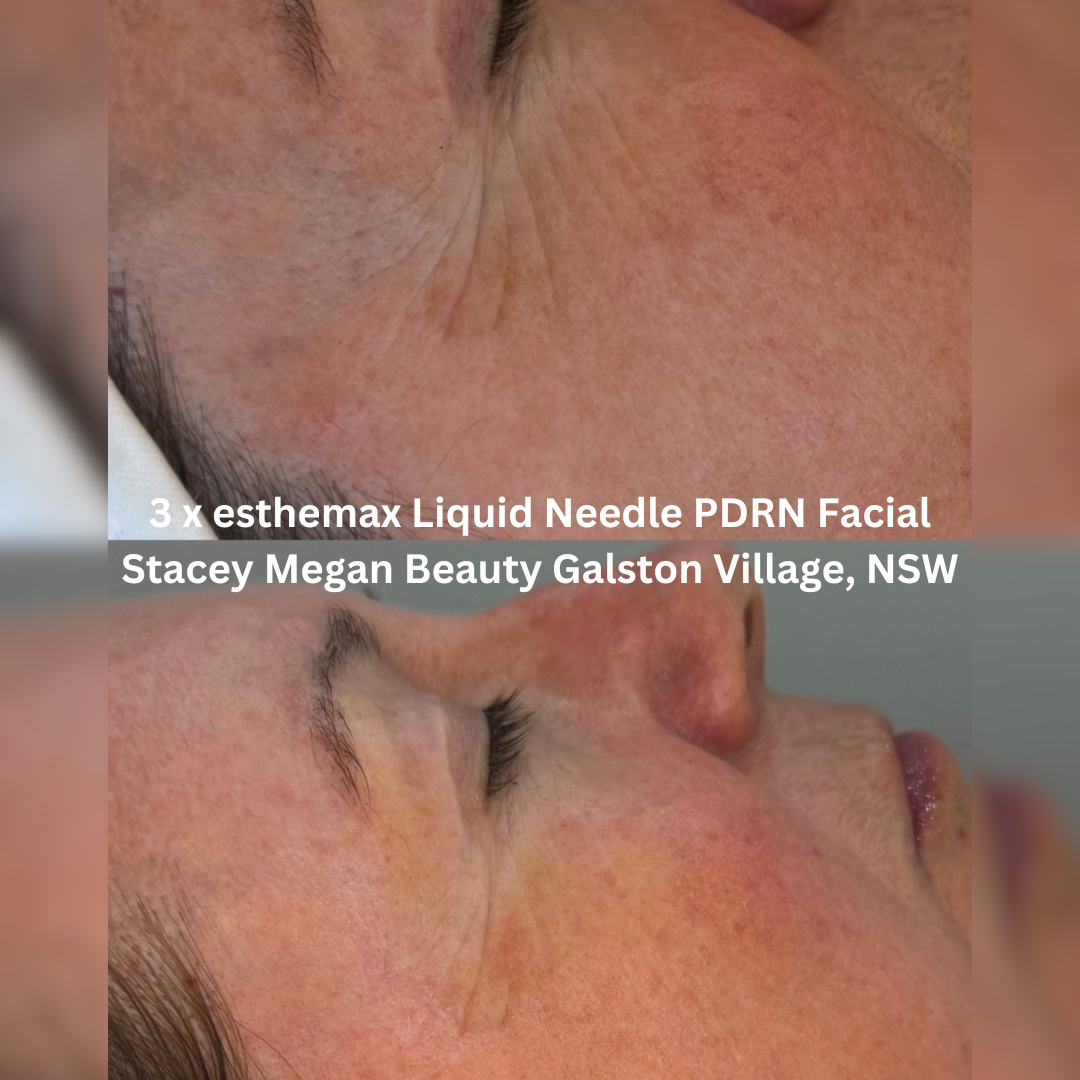 Before and after three esthemax Liquid Needle PDRN Facial treatments, showing refined skin texture, improved radiance and a more even-looking complexion.