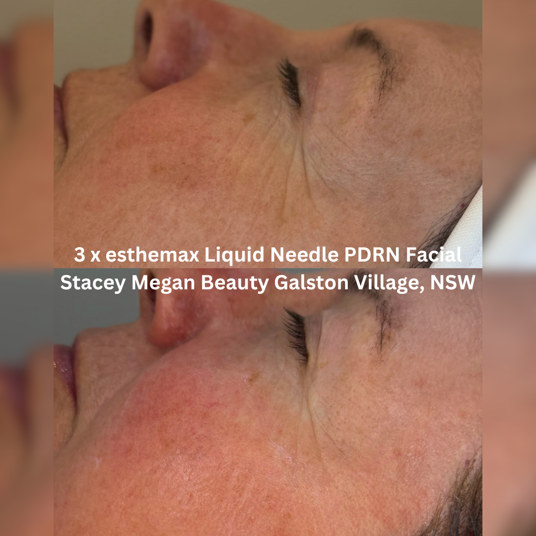 Before and after three esthemax Liquid Needle PDRN Facial treatments, showing refined skin texture, improved radiance and a more even-looking complexion.