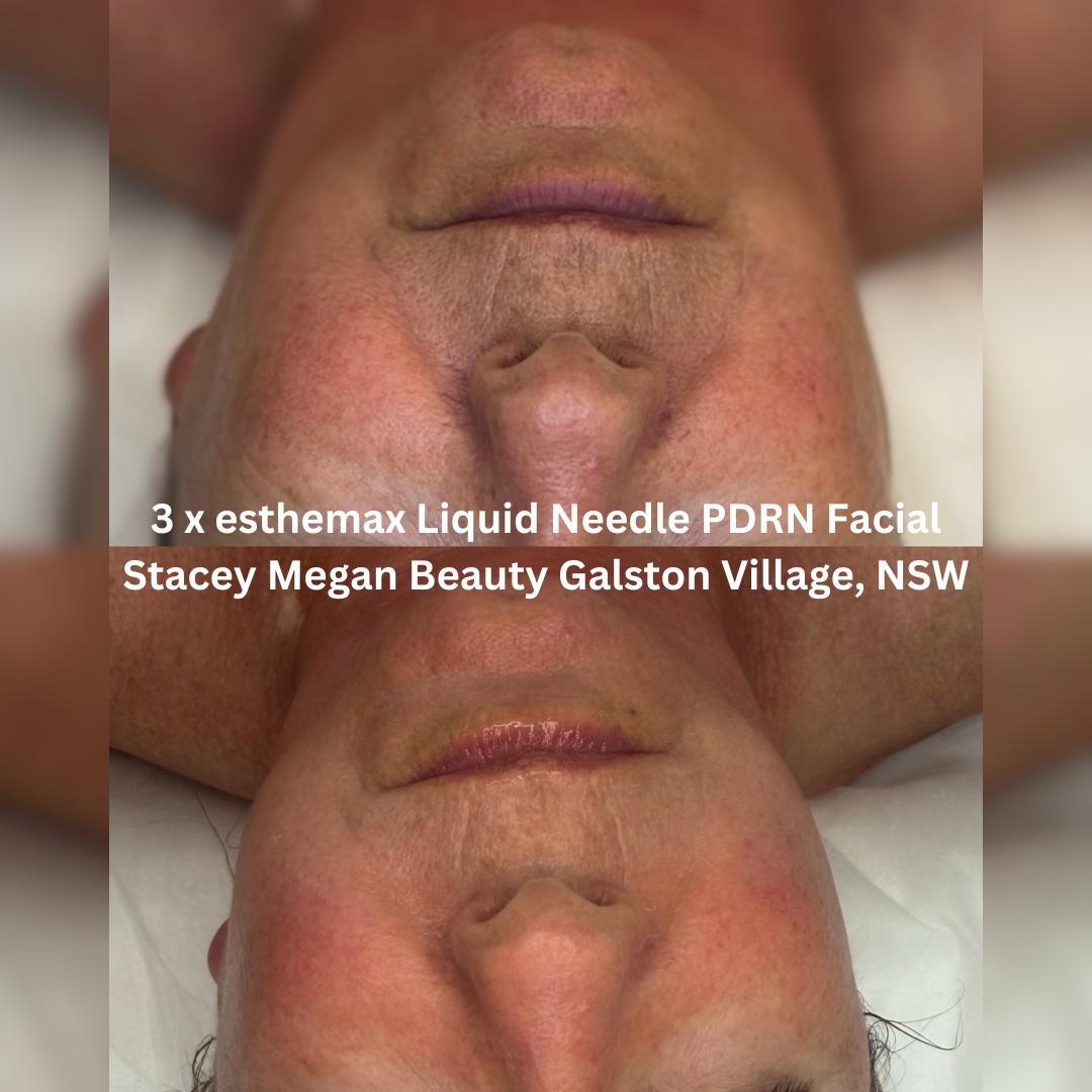 Before and after three esthemax Liquid Needle PDRN Facial treatments, showing improved hydration, softer-looking texture and increased skin radiance.