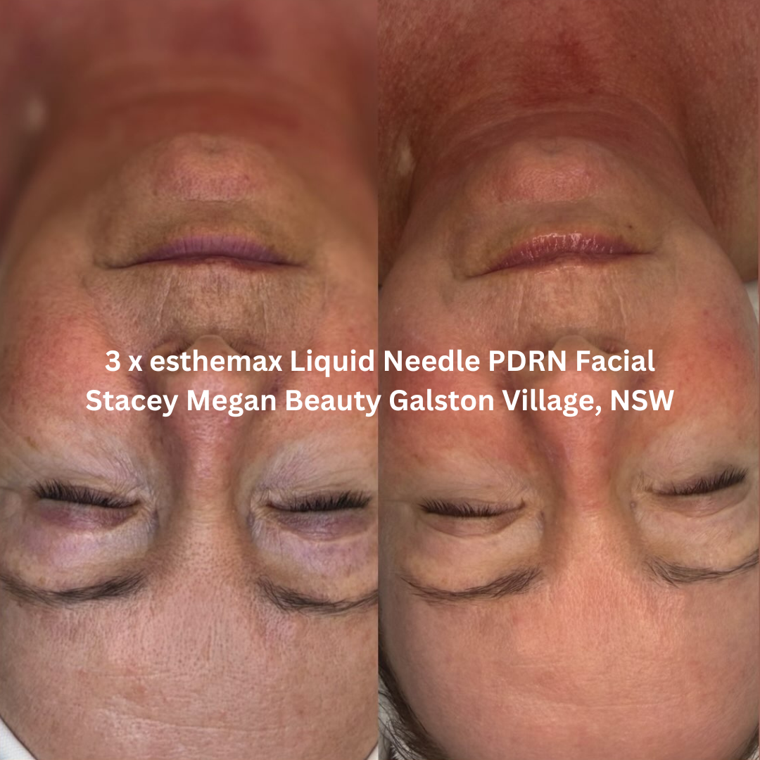 Before and after three esthemax Liquid Needle PDRN Facial treatments, showing improved skin smoothness, brightness and a more even-looking complexion.