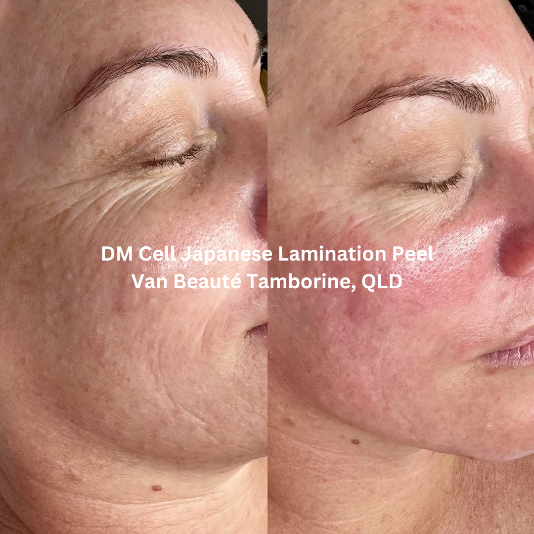 Before and after results of a DM Cell Japanese Lamination Peel performed at Van Beaute in Tamborine, Queensland. The skin appears smoother, brighter, and more refined in texture, showing improved clarity and luminosity post-treatment.