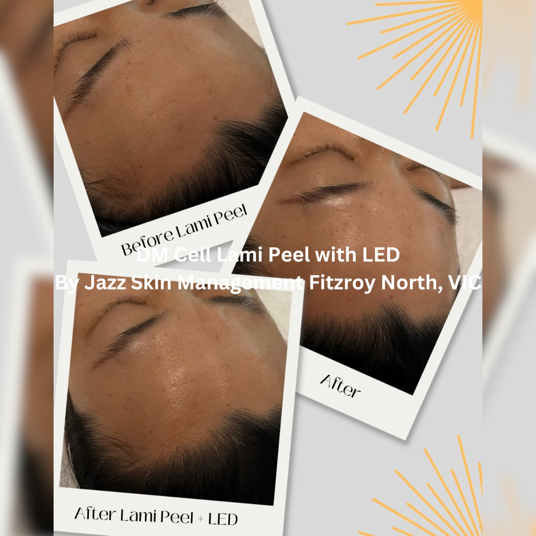 Before and after images of the forehead following a DM Cell Lami Peel with LED treatment at Jazz Skin Management in Fitzroy North, Victoria. The after images show visibly smoother-looking skin with improved hydration and a more refined, radiant surface appearance.