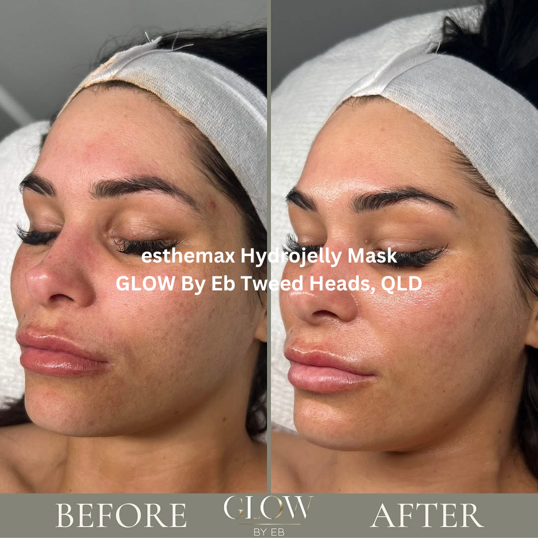 Before and after side-profile images following a facial treatment with an esthemax® Hydrojelly® Mask at GLOW By Eb in Tweed Heads, Queensland. The after image shows visibly brighter, more hydrated skin with enhanced glow and a smoother overall complexion.
