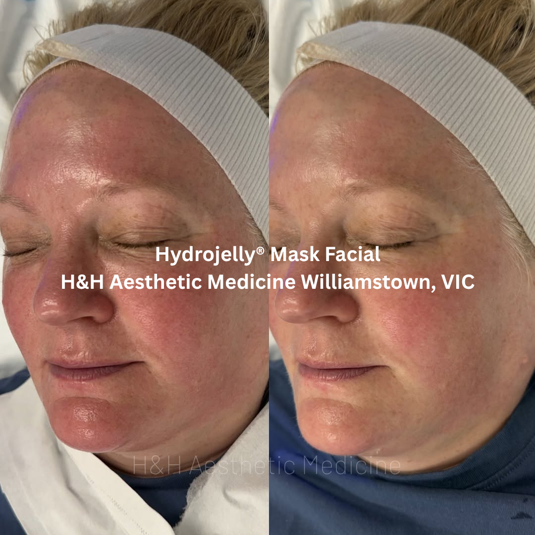 Before and after images of the face following an esthemax Hydrojelly® Mask Facial at H&H Aesthetic Medicine in Williamstown, Victoria. The after image shows visibly calmer skin with reduced redness, improved hydration, and a more balanced complexion.