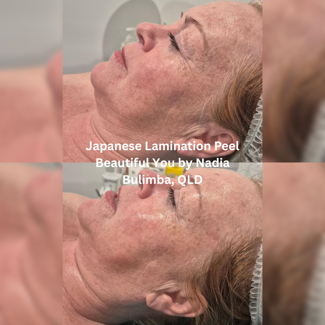 Side profile before and after images following a Japanese Lamination Peel at Beautiful You by Nadia in Bulimba, Queensland. The after image shows smoother-looking skin with improved hydration, brightness, and a more even surface appearance.