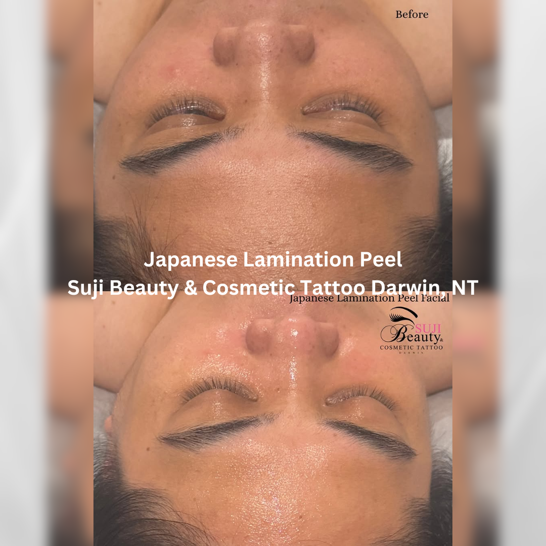 Before and after images of the face following a Japanese Lamination Peel at Suji Beauty & Cosmetic Tattoo in Darwin, Northern Territory. The after image shows a brighter, more refined complexion with smoother texture and improved overall radiance.