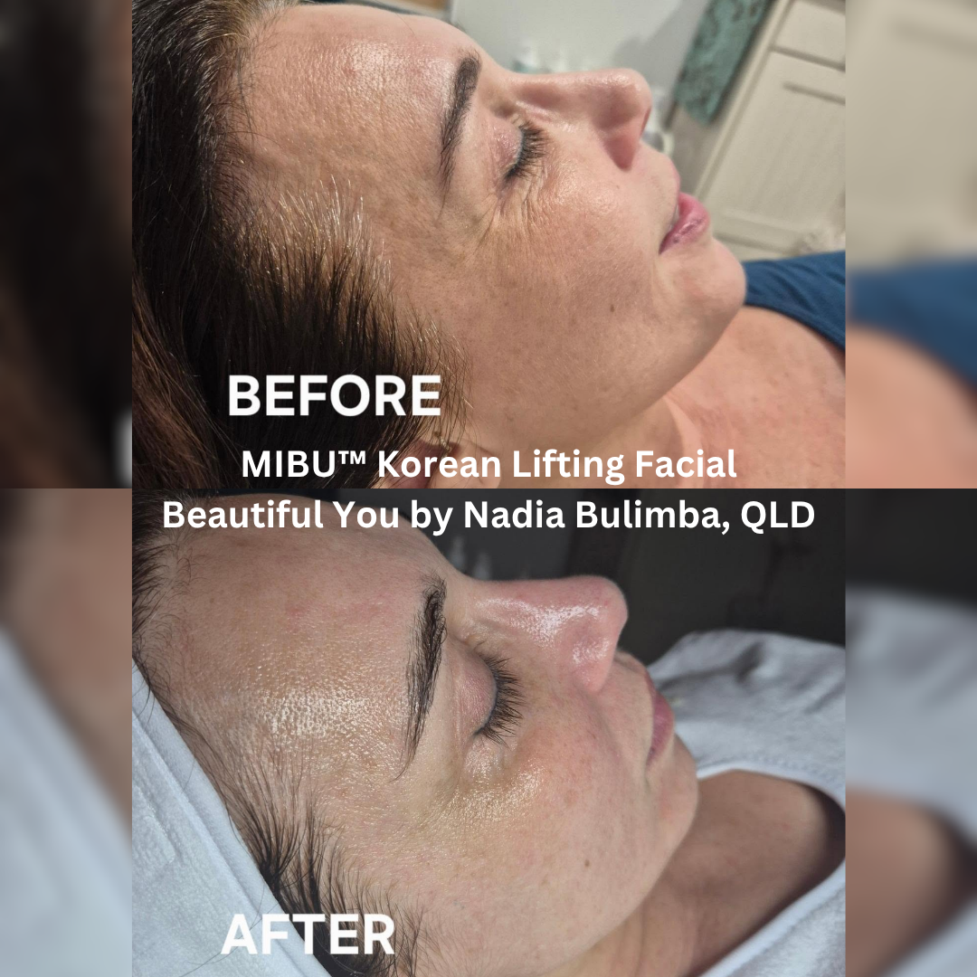Before and after MIBU™ Korean Lifting Facial at Beautiful You by Nadia, Bulimba QLD, showing a more refreshed, luminous complexion with smoother-looking skin and a visibly hydrated appearance.