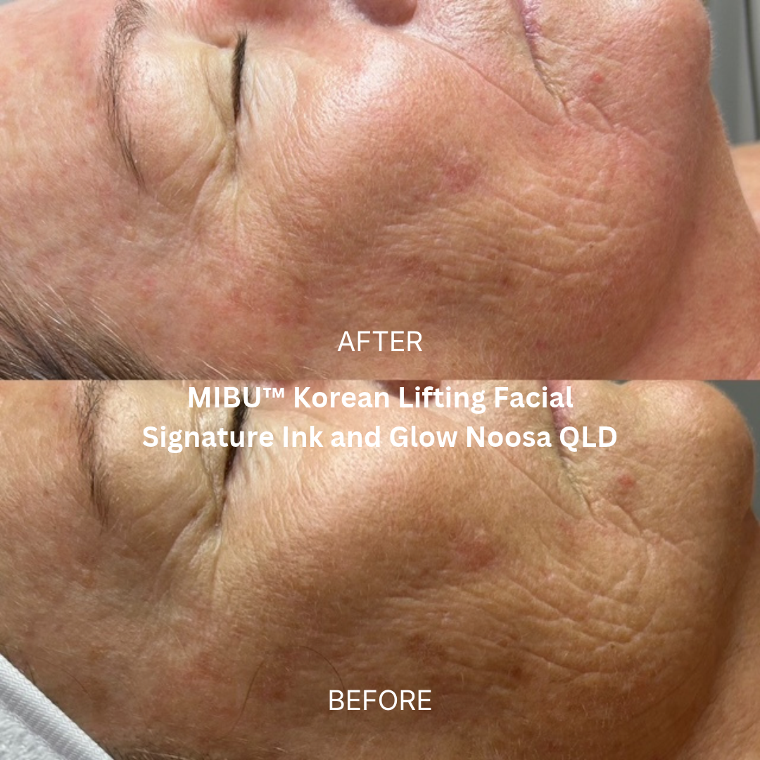 Before and after two MIBU™ Korean Lifting Facial treatments at Skin Artistry By Claudia, Latrobe TAS, showing the cheek and eye area with enhanced skin luminosity, smoother-looking texture and a refreshed appearance.