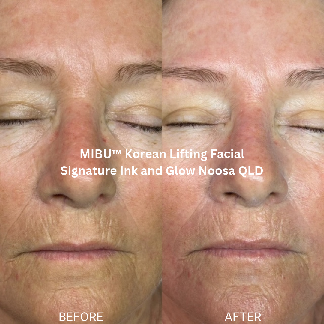 Before and after MIBU™ Korean Lifting Facial at Signature Ink and Glow, Noosa QLD, showing enhanced skin radiance, a smoother-looking complexion and softened appearance of fine lines around the mouth.