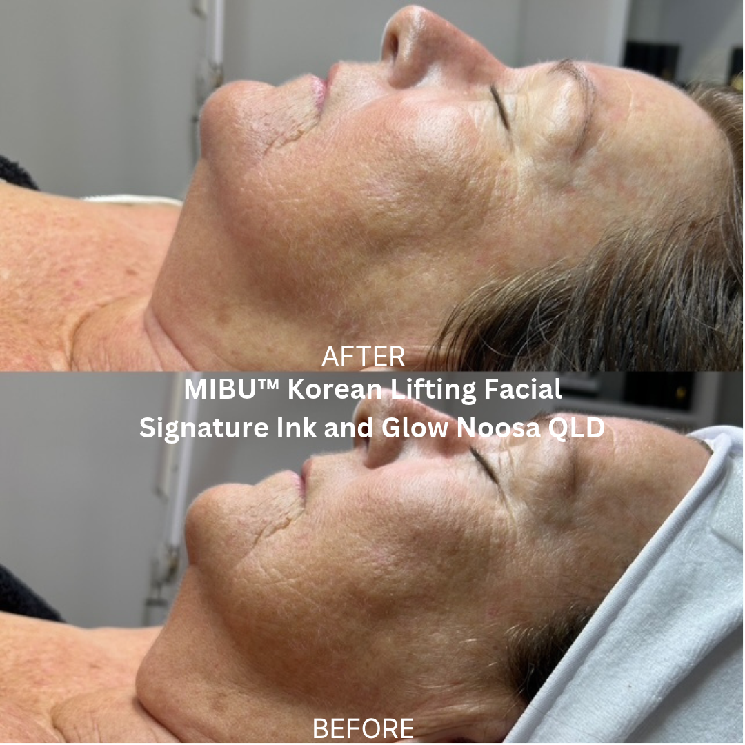 Before and after MIBU™ Korean Lifting Facial at Signature Ink and Glow, Noosa QLD, showing the side profile with a smoother-looking jawline, improved skin luminosity and a refreshed appearance.