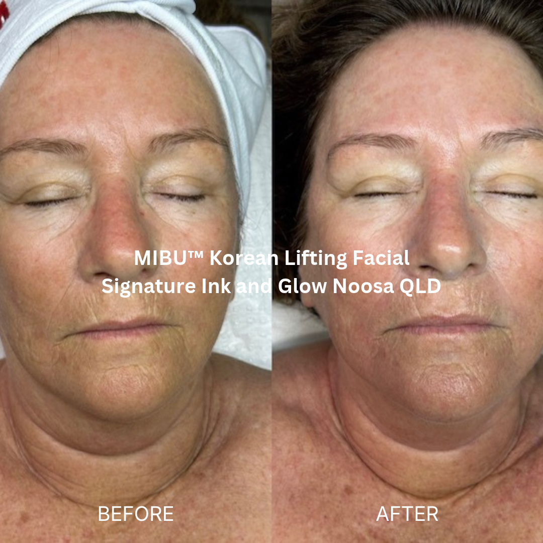 Before and after MIBU™ Korean Lifting Facial at Signature Ink and Glow, Noosa QLD, showing a more luminous, hydrated-looking complexion with smoother skin texture and a refreshed overall appearance.