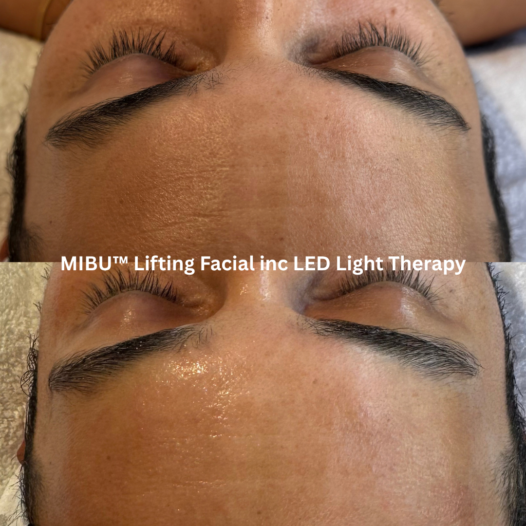 Before and after MIBU™ Lifting Facial with LED Light Therapy showing smoother-looking forehead texture, softened fine lines and increased skin radiance.