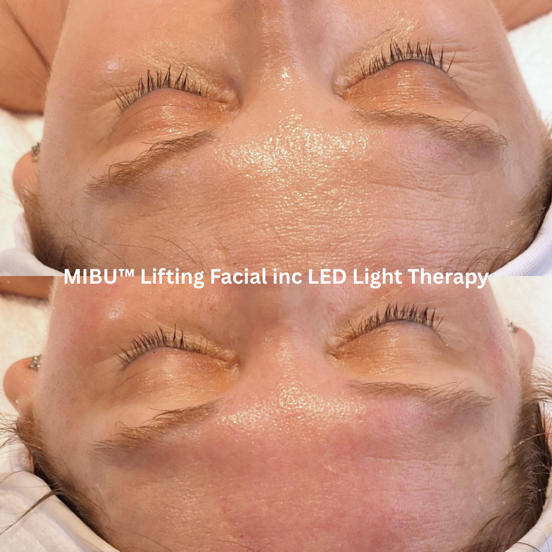 Before and after MIBU™ Lifting Facial with LED Light Therapy showing smoother-looking forehead texture, softened fine lines and increased skin radiance.