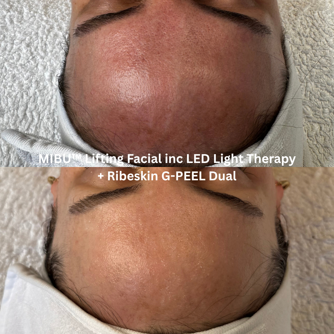 Before and after close-up of the forehead following MIBU™ Lifting Facial with LED Light Therapy and Ribeskin G-PEEL Dual, showing visibly smoother-looking texture, refined skin appearance and enhanced radiance.