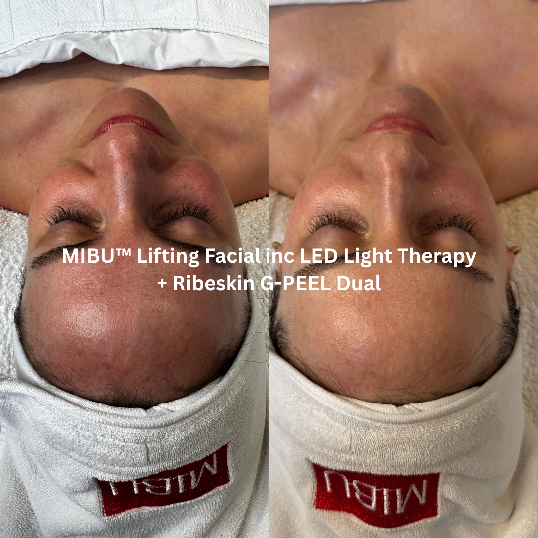 Before and after MIBU™ Lifting Facial with LED Light Therapy and Ribeskin G-PEEL Dual, showing a smoother, more luminous complexion with improved skin texture and a more even-looking forehead.