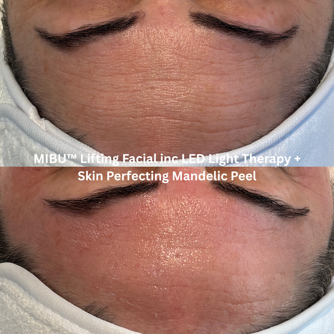 Before and after MIBU™ Lifting Facial with LED Light Therapy and Skin Perfecting Mandelic Peel, showing smoother-looking forehead texture, softened fine lines and increased skin radiance.