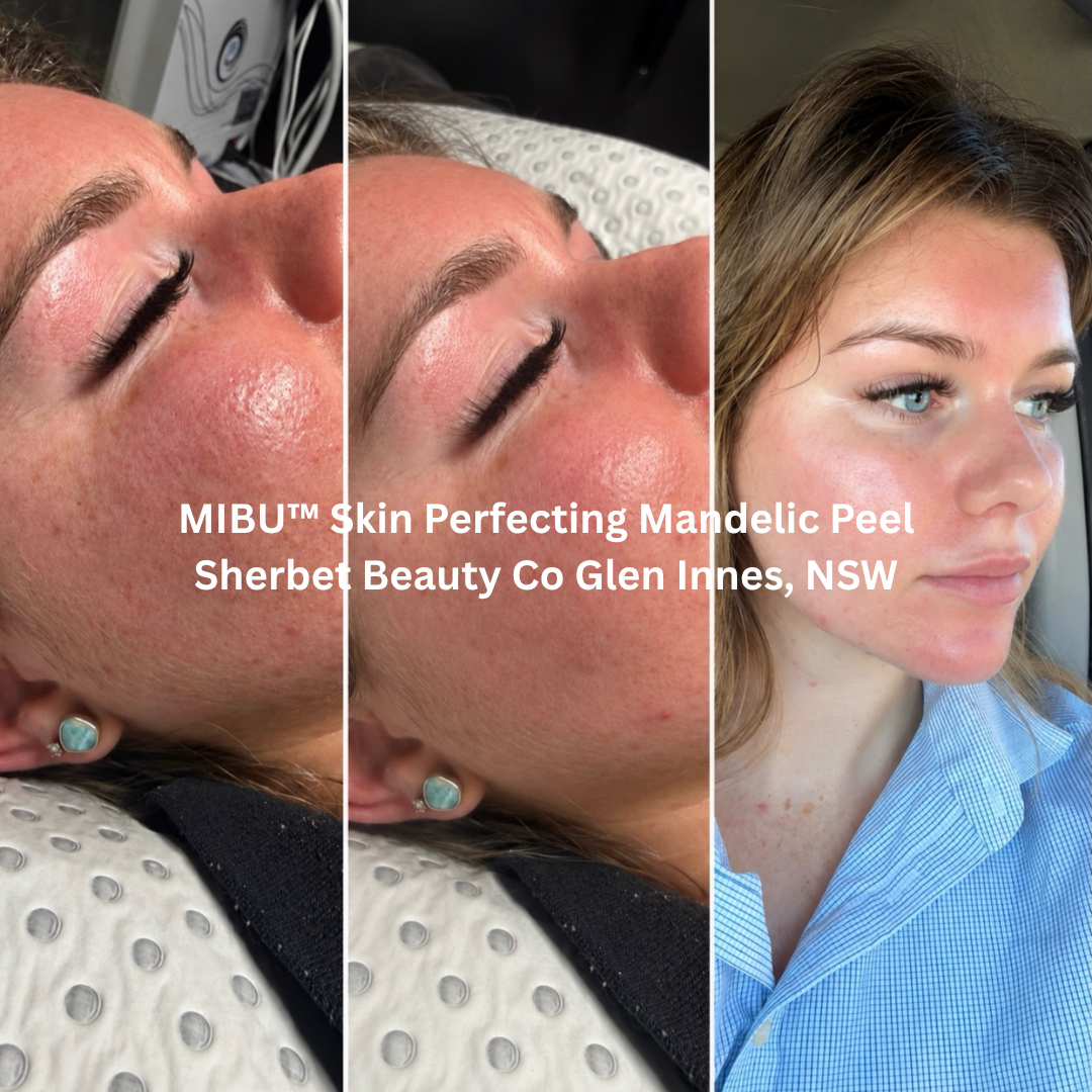 Before and after MIBU™ Skin Perfecting Mandelic Peel at Sherbet Beauty Co, Glen Innes NSW, showing a brighter, more refreshed complexion with smoother-looking skin and improved overall radiance.