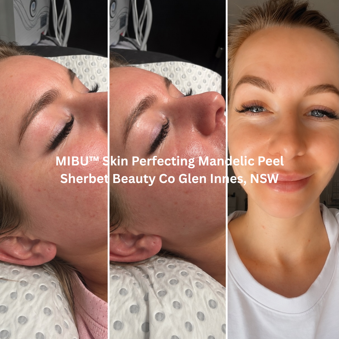 Before and after MIBU™ Skin Perfecting Mandelic Peel at Sherbet Beauty Co, Glen Innes NSW, showing a brighter, more even-looking complexion with visibly smoother skin texture, reduced appearance of blemishes and enhanced radiance.