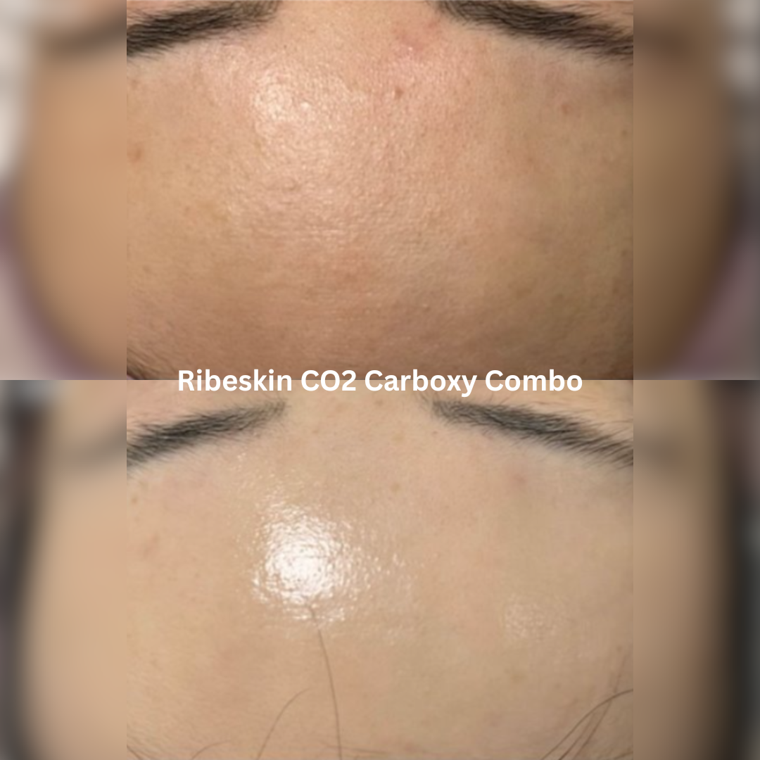 Before and after RIBESKIN CO₂ Carboxy treatment, showing smoother-looking forehead texture, improved skin clarity and a brighter, more luminous finish.