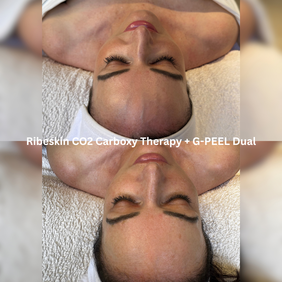 Before and after Ribeskin CO2 Carboxy Therapy combined with G-PEEL Dual, showing a brighter, more even-looking complexion with reduced visible redness and a refreshed skin appearance.
