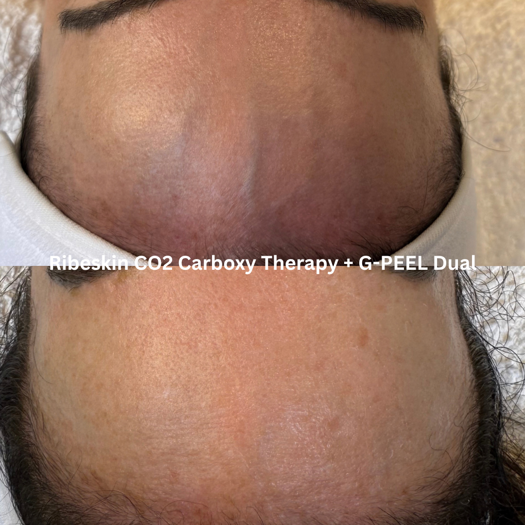 Before and after Ribeskin CO2 Carboxy Therapy combined with G-PEEL Dual, showing a more even-looking forehead with reduced visible redness, smoother texture and improved skin clarity.